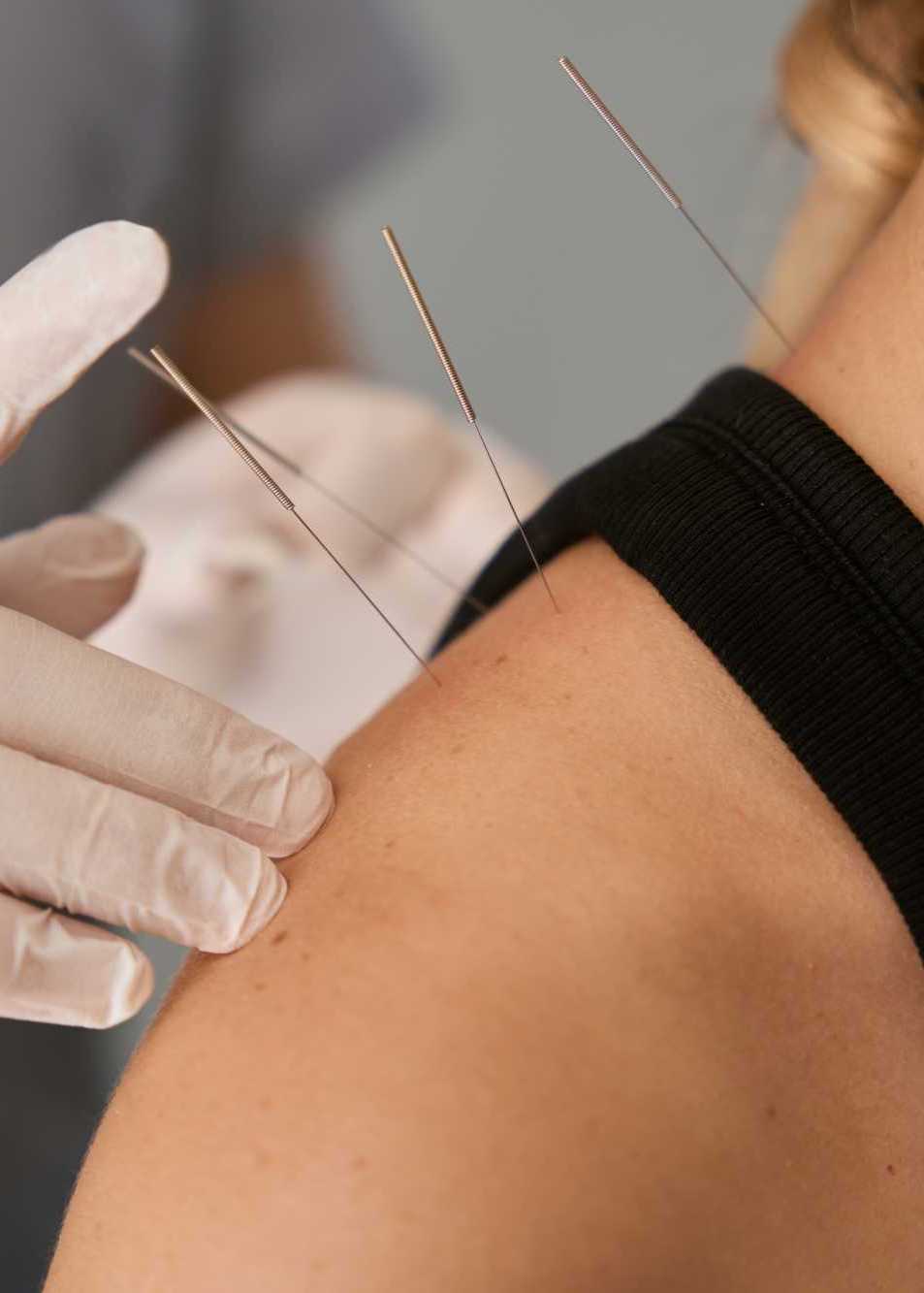 acupuncture